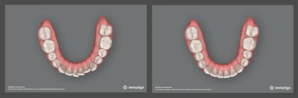 Лечение с помощью Invisalign: преимущества элайнеров для исправления неправильно расположенных зубов