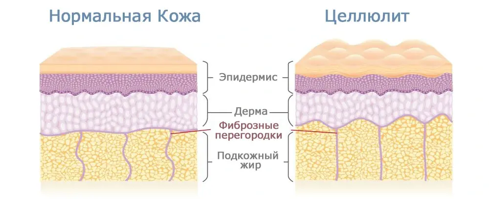 Можно ли быстро избавиться от целлюлита? Информация и советы для реалистичных ожиданий