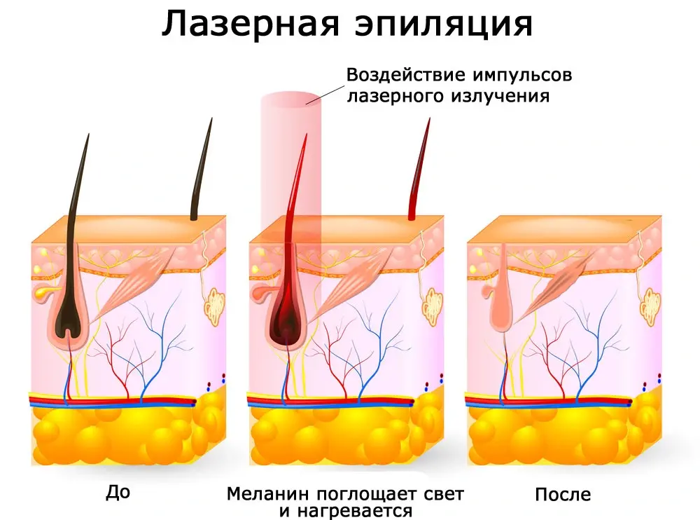 Эффективный диодный лазер: постоянное и бережное удаление волос