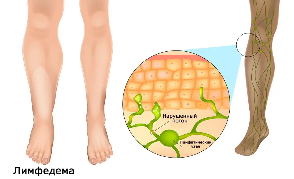 Успешное лечение лимфатического отёка - компрессия, лимфодренаж и другие полезные меры