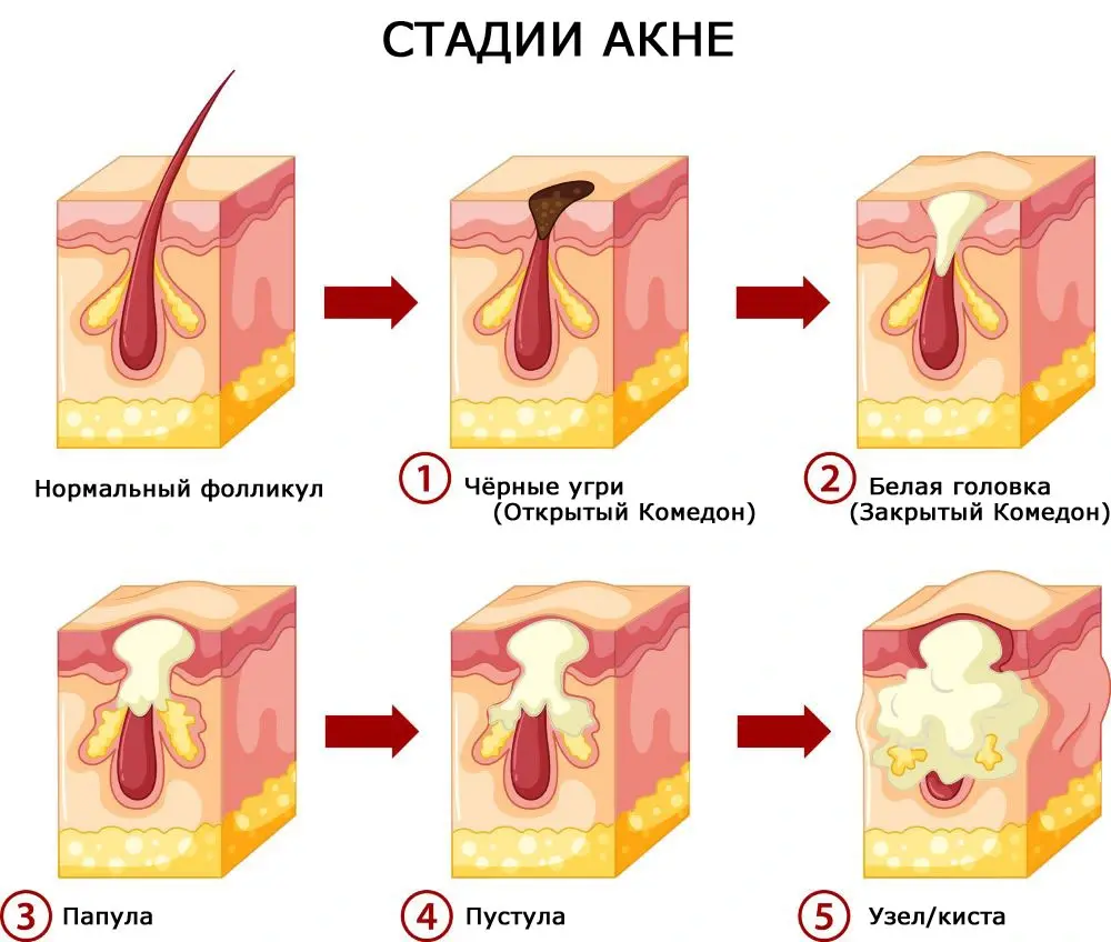 Что помогает от акне?